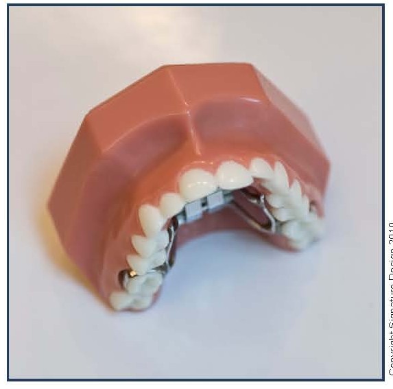 Banded Palatal Expander (PE)